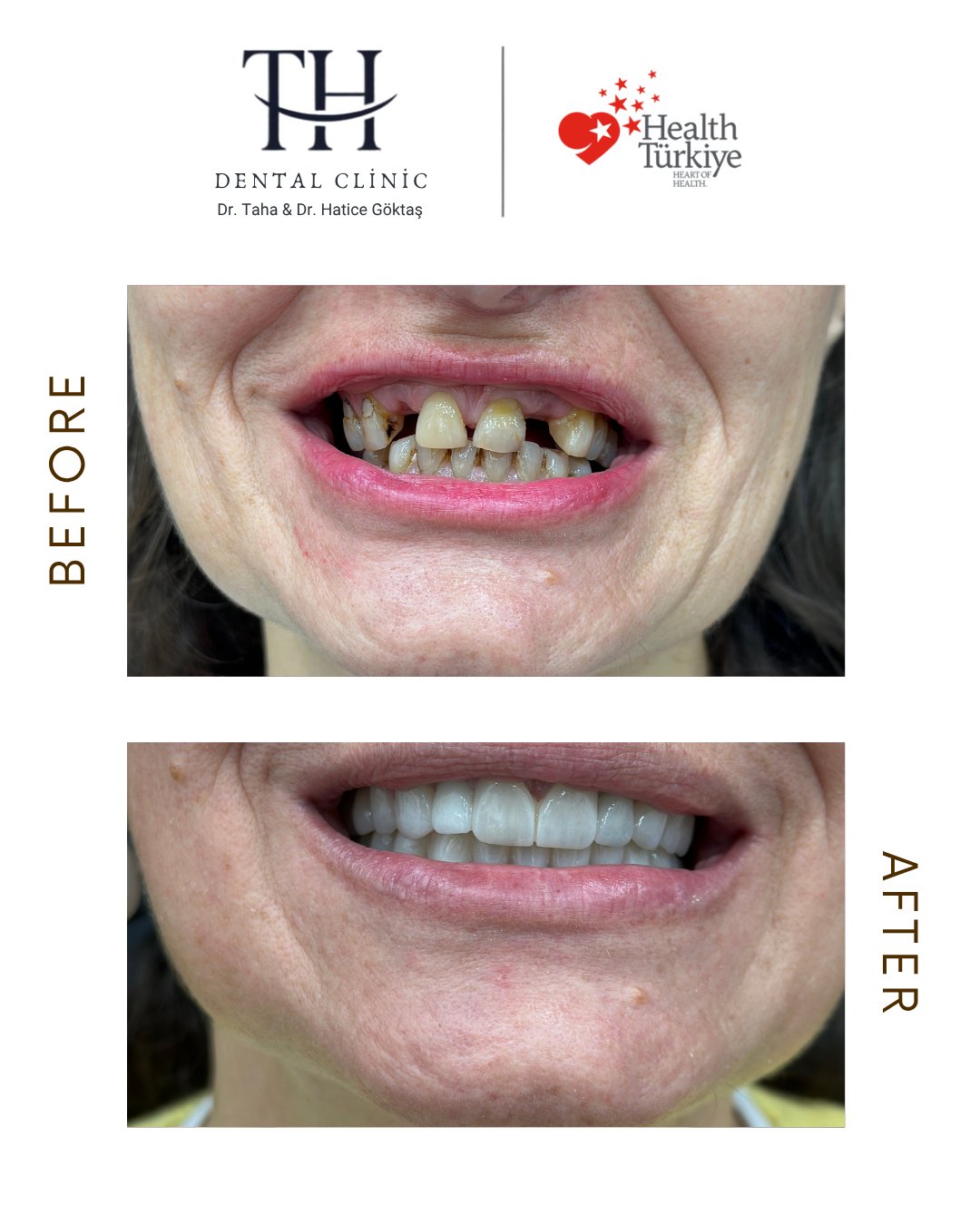 All on 6 - TH Dental Clinic