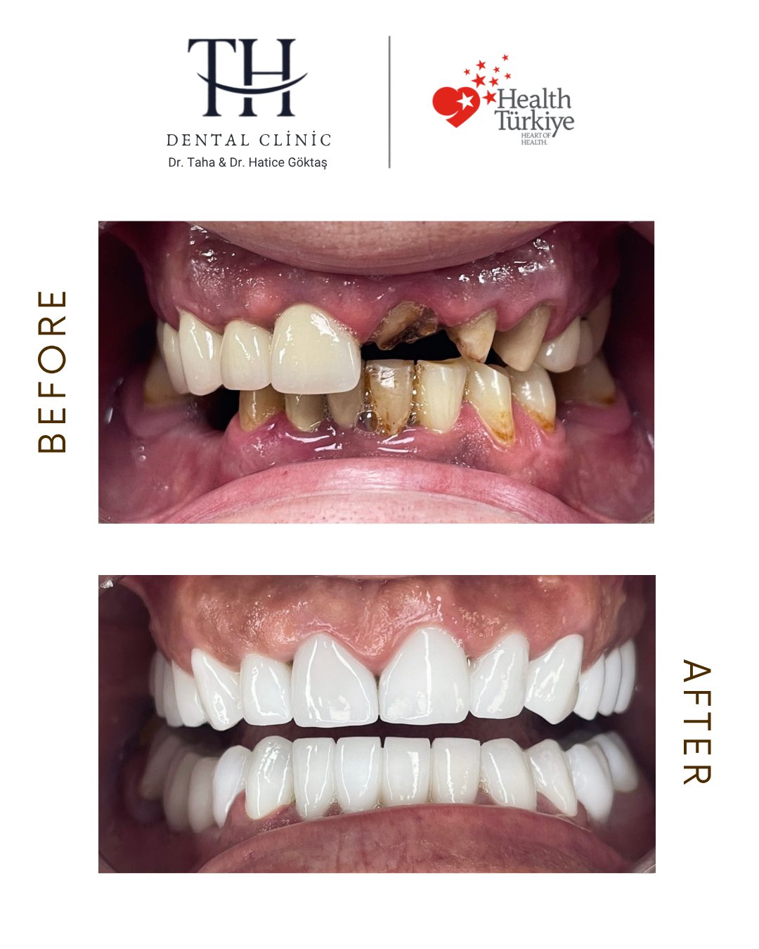 Dental Implant - TH Dental Istanbul