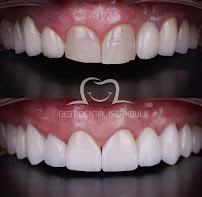 Best Dental İstanbul | Veneers | Implants | Crowns