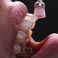 Best Dental İstanbul | Veneers | Implants | Crowns