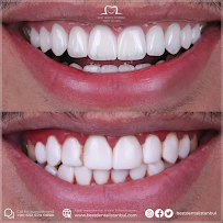 Best Dental İstanbul | Veneers | Implants | Crowns