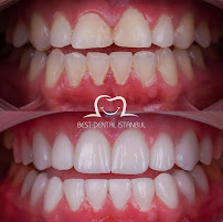 Best Dental İstanbul | Veneers | Implants | Crowns