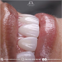 Best Dental İstanbul | Veneers | Implants | Crowns