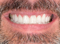 Dental Estetik