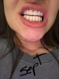 Dental Estetik