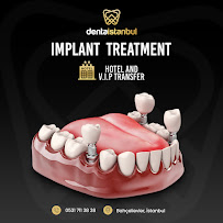 Denta İstanbul Diş Kliniği | Denta Istanbul Clinic | Dental Implants & Dental Veneer & Smile Design