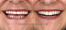 Karaçor Clinics | Smile Design | Laminate Veneer | Emax | Gülüş Tasarımı | Implant | Dentist | Adem Can Karaçor | Olcay Bakar