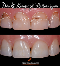 Karaçor Clinics | Smile Design | Laminate Veneer | Emax | Gülüş Tasarımı | Implant | Dentist | Adem Can Karaçor | Olcay Bakar
