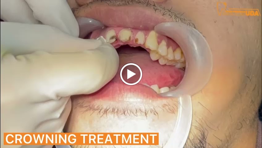 Klinik Pergigian Uda , Braces , Denture , Bridge , Crown - dental clinic in Johor Bahru, Malaysia