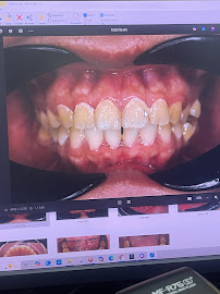 Kuo Dental - JB dentist | Angelalign KOL | Invisalign | Dental Implant | Piezo Assisted Wisdom Tooth Surgery