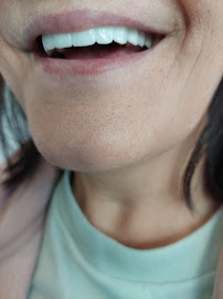 Avangart Clinic - Dental Implants Turkey | Best Istanbul Dental Clinic Turkey | Crowns | Veneers | Hollywood Smile