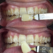 Le Dental Clinic | Painless Implant, Holistic Root Canal Treatment & Digital Veneers Centre 无痛种植牙，根管治疗 & 美牙牙贴片中心