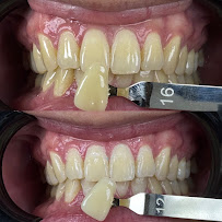 Le Dental Clinic | Painless Implant, Holistic Root Canal Treatment & Digital Veneers Centre 无痛种植牙，根管治疗 & 美牙牙贴片中心