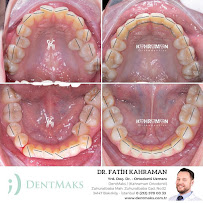DentMax İstanbul Bakırköy Ağız ve Diş Sağlığı Polikliniği / Ortodonti - invisalign - implant - Lamine - MARPE