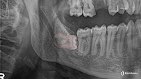 DentMax İstanbul Bakırköy Ağız ve Diş Sağlığı Polikliniği / Ortodonti - invisalign - implant - Lamine - MARPE
