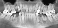 DentMax İstanbul Bakırköy Ağız ve Diş Sağlığı Polikliniği / Ortodonti - invisalign - implant - Lamine - MARPE