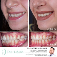 DentMax İstanbul Bakırköy Ağız ve Diş Sağlığı Polikliniği / Ortodonti - invisalign - implant - Lamine - MARPE