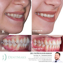 DentMax İstanbul Bakırköy Ağız ve Diş Sağlığı Polikliniği / Ortodonti - invisalign - implant - Lamine - MARPE