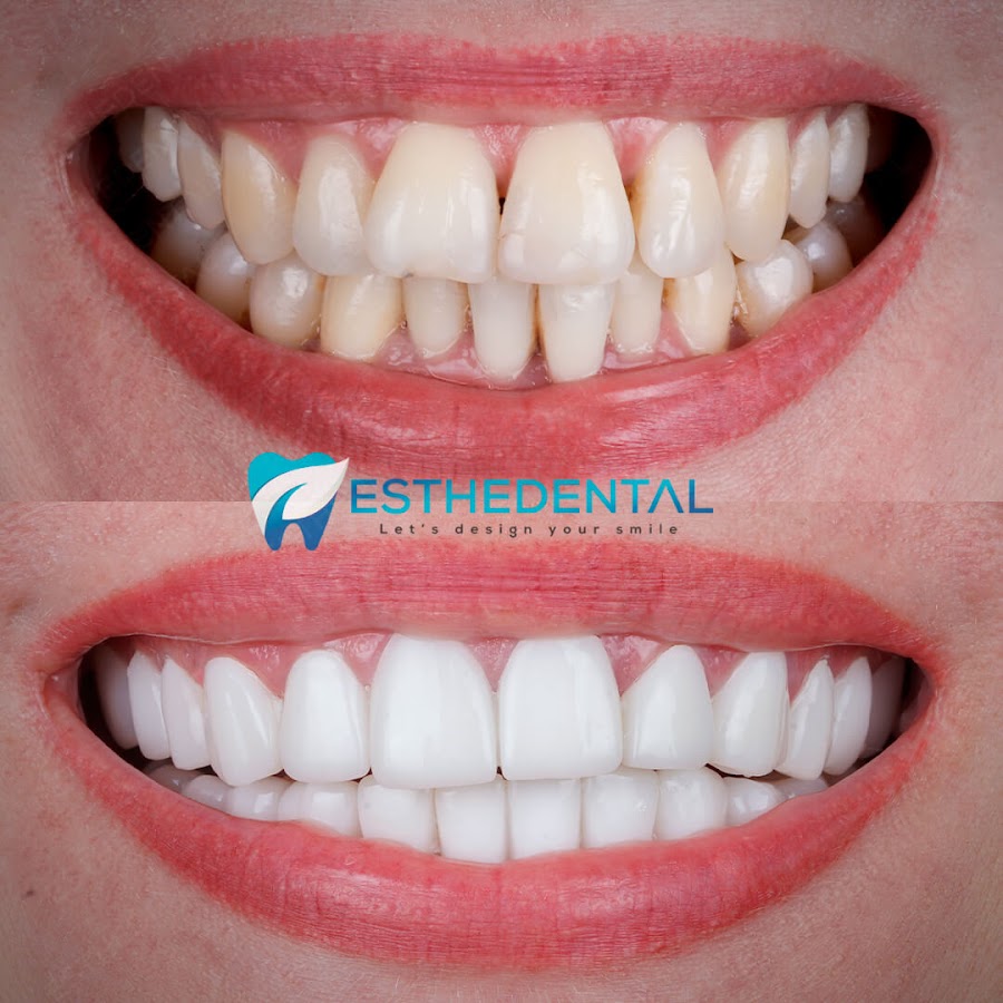 EstheDental - Cosmetic Dentistry in Turkey
