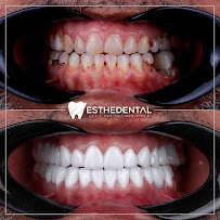 EstheDental - Cosmetic Dentistry in Turkey