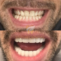EstheDental - Cosmetic Dentistry in Turkey