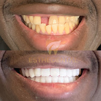 EstheDental - Cosmetic Dentistry in Turkey