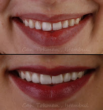 ISTANBUL DENTAL CLINICS Turkey | Dentist | Veneers | Dental Implants | Crowns | Hollywood Smile Design