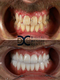 Digital Dental Center Pattaya - Specialized Dental Implant and Cosmetic, the Invisalign Diamond Provider in Pattaya.