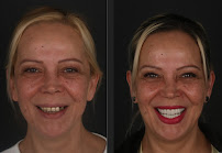 İdea Dental Clinic | dental implant | hollywood smile | gülüş tasarımı | ortodonti diş tedavisi | diş estetiği beyazlatma