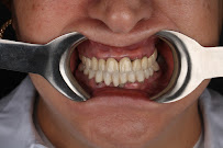 İdea Dental Clinic | dental implant | hollywood smile | gülüş tasarımı | ortodonti diş tedavisi | diş estetiği beyazlatma