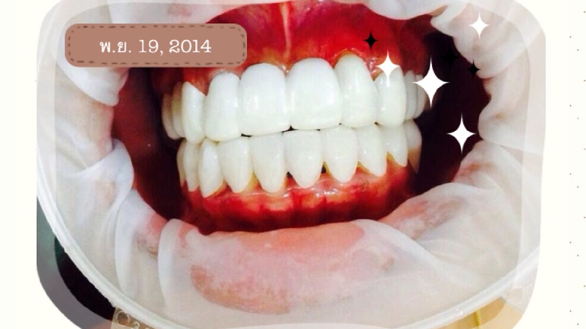 dentalpoint pattaya เด็นทัลพอยท์ คลินิกหมอหลินจัดฟันเหล็ก จัดฟันแบบใส รีเทนเนอร์ ฟันขาว ทำฟัน พัทยา