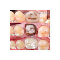 Dental 21 PIK | Klinik Premium Spesialis Memperbaiki Gigi Rusak