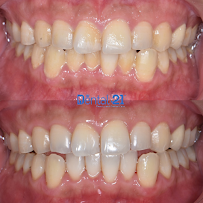 Dental 21 PIK | Klinik Premium Spesialis Memperbaiki Gigi Rusak