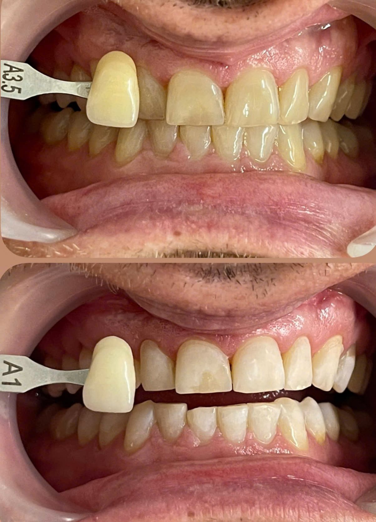 Before/after dental result at Tri Hao Dental Clinic Phu Quoc