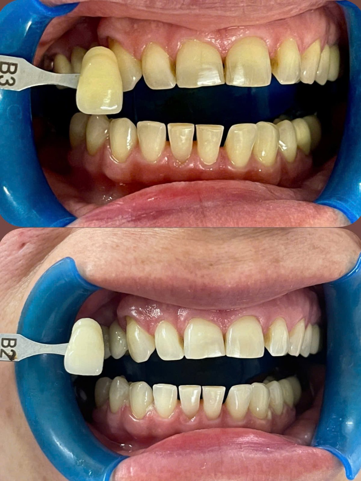 Before/after dental result at Tri Hao Dental Clinic Phu Quoc