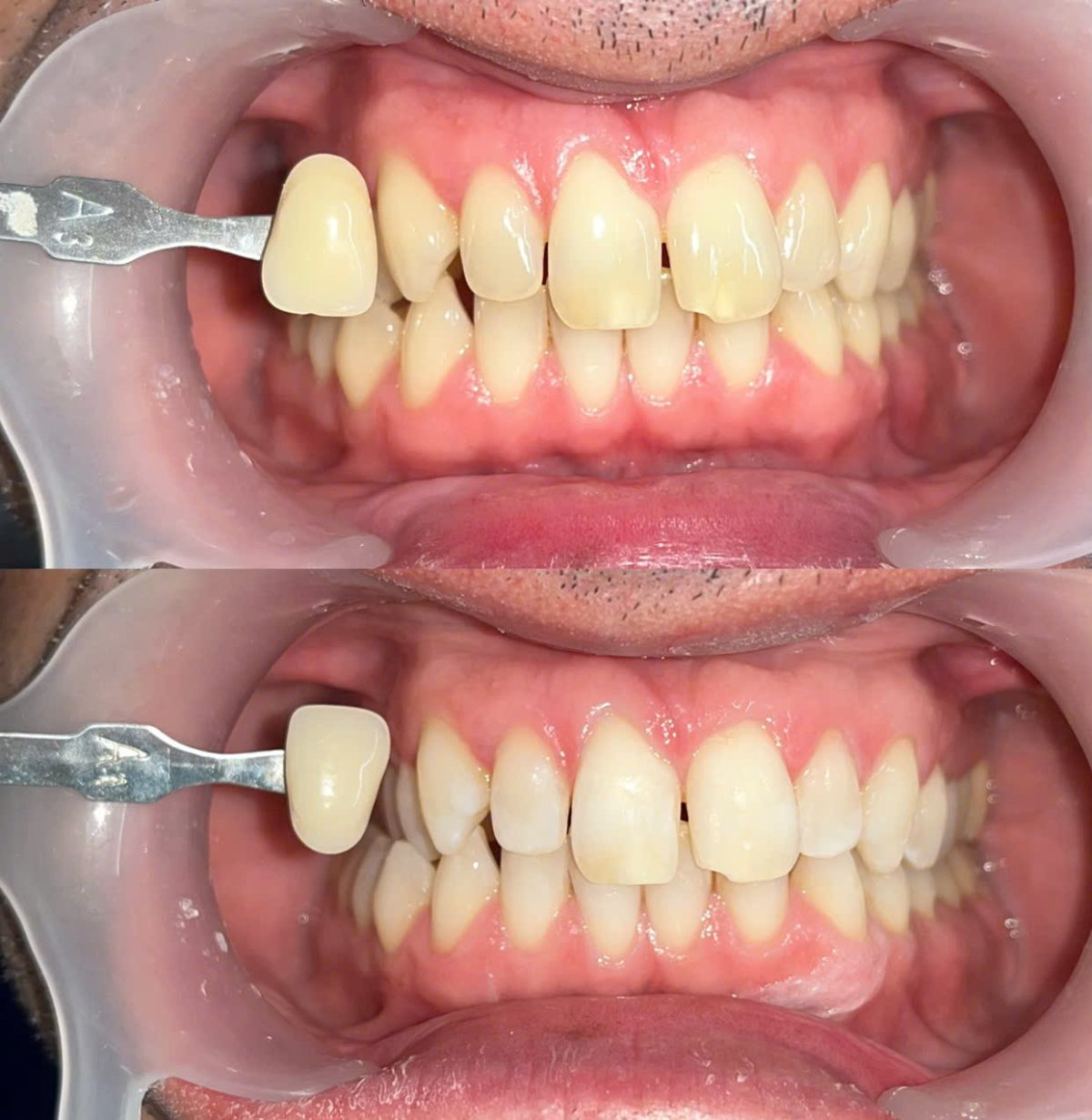 Before/after dental result at Tri Hao Dental Clinic Phu Quoc