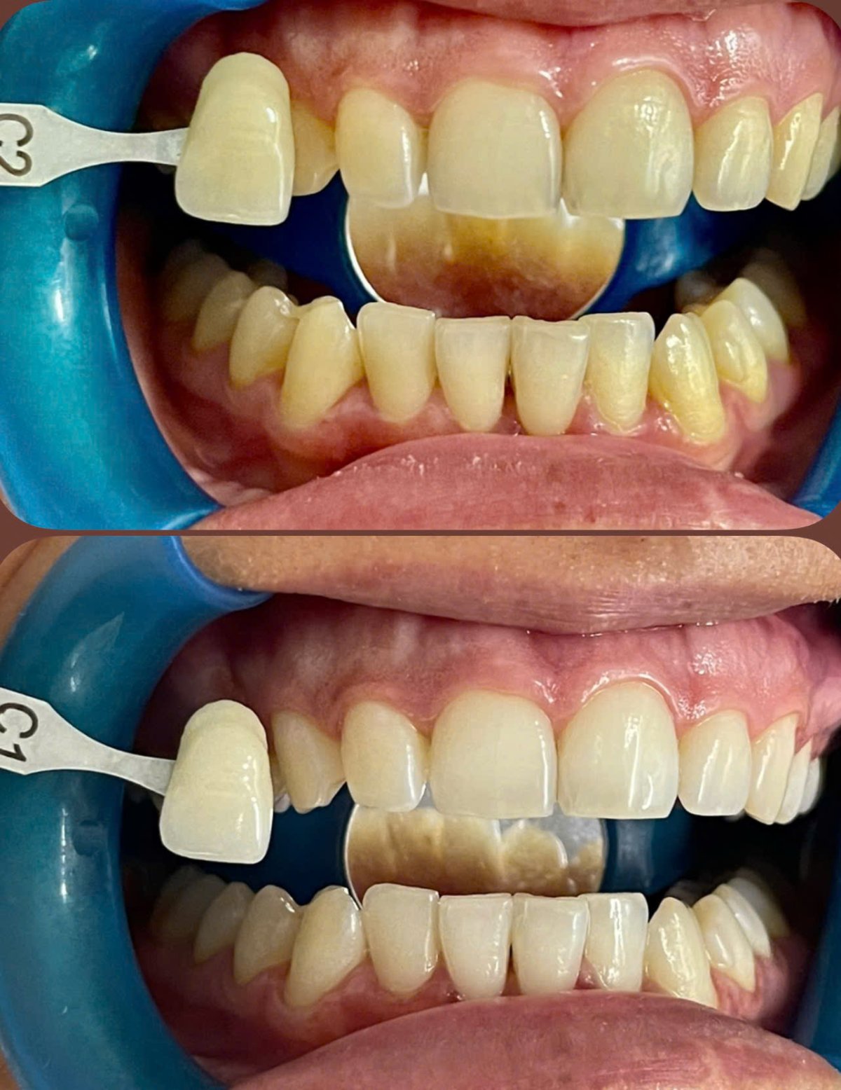 Before/after dental result at Tri Hao Dental Clinic Phu Quoc