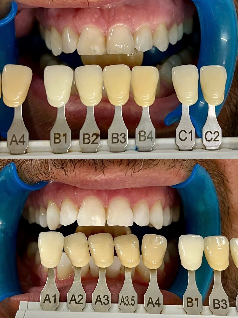 Before/after dental result at Tri Hao Dental Clinic Phu Quoc