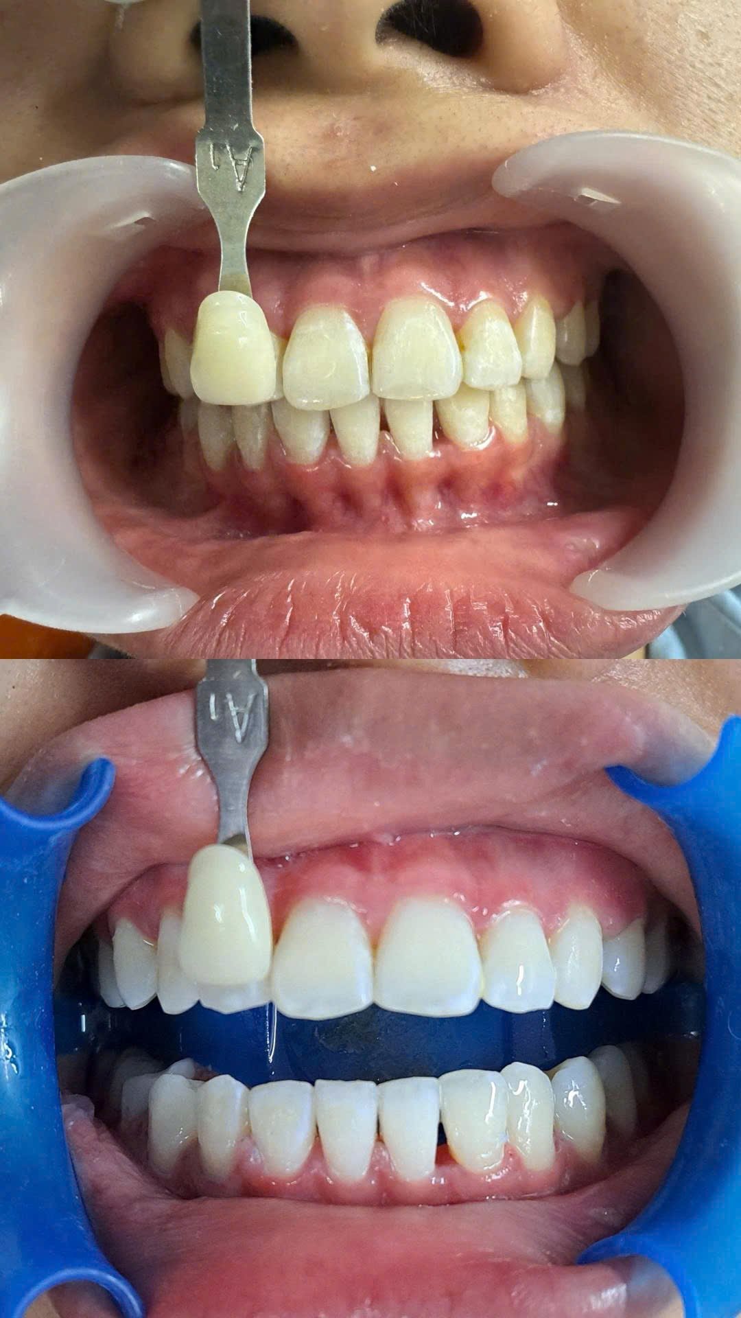 Before/after dental result at Tri Hao Dental Clinic Phu Quoc