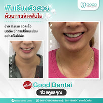 Good dental clinic Kathu Phuket คลินิกทันตกรรมกู๊ด กะทู้ จัดฟัน ฟอกฟันขาว รักษารากฟัน รากฟันเทียม ครอบฟัน วีเนียร์ ภูเก็ต