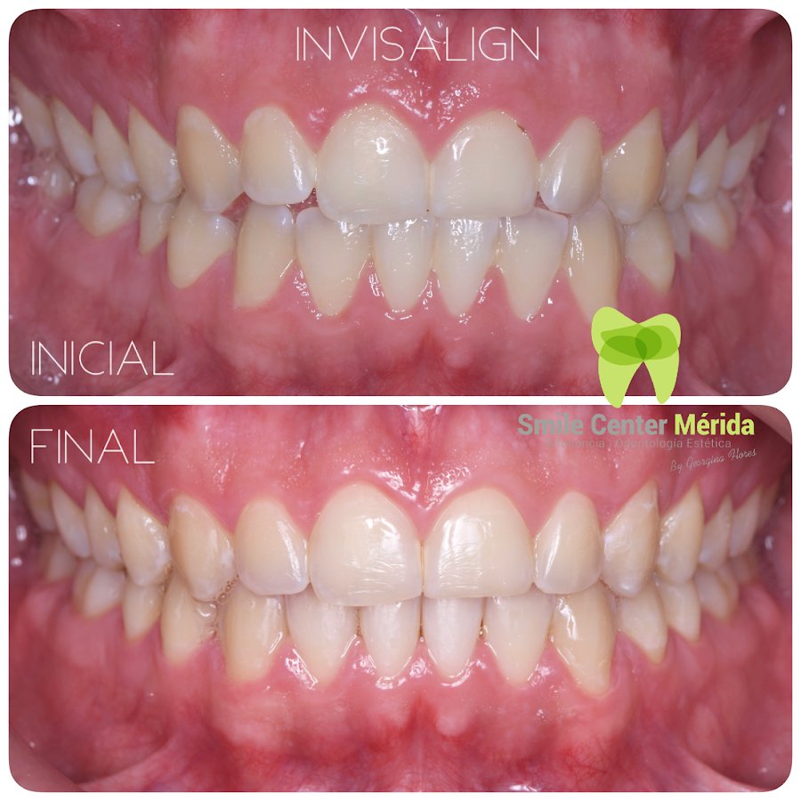 Before/after dental result at Smile Center Mérida By Georgina Flores Avalos