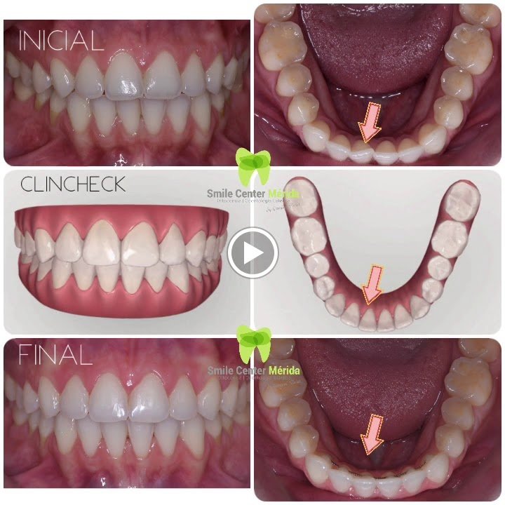 Before/after dental result at Smile Center Mérida By Georgina Flores Avalos