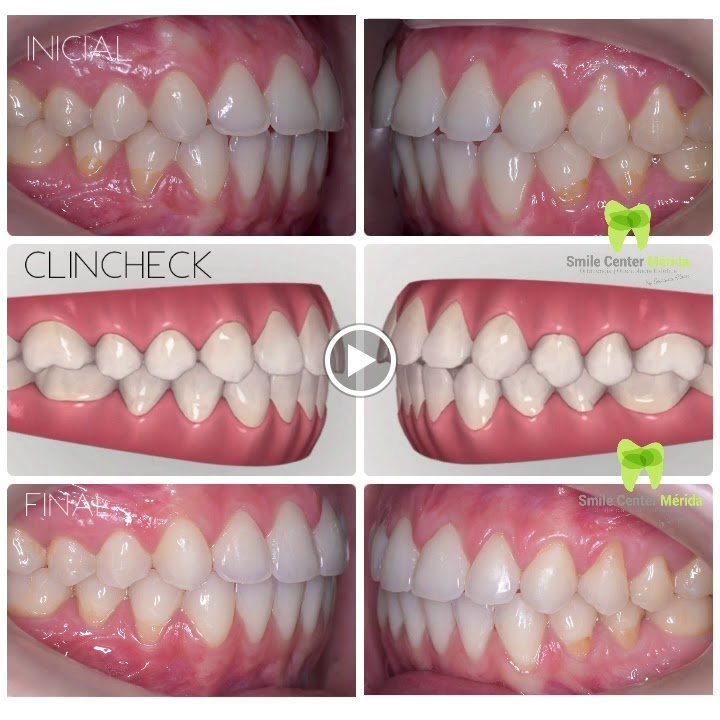 Before/after dental result at Smile Center Mérida By Georgina Flores Avalos
