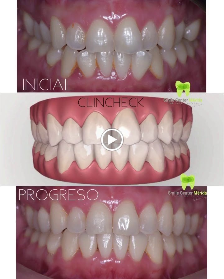 Before/after dental result at Smile Center Mérida By Georgina Flores Avalos