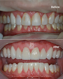 Dental Solutions Puerto Vallarta