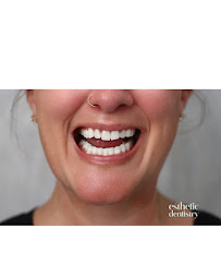 Esthetic Dentistry in Puerto Vallarta