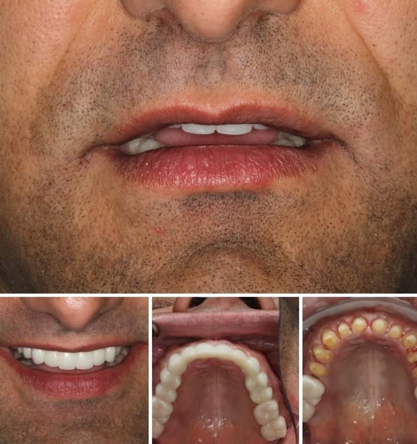 International Dental Center PV Cosmetic Dentistry and Dental Implants - dental clinic in Puerto Vallarta, Mexico