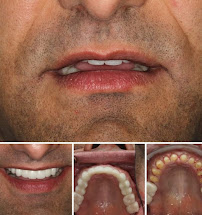 International Dental Center PV Cosmetic Dentistry and Dental Implants in Puerto Vallarta, Mexico