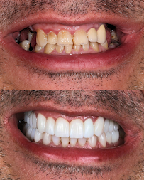 Warsaw Dental Academy Implanty Licówki Bonding