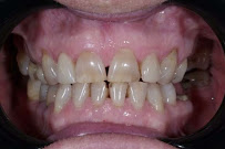 Warsaw Dental Academy Implanty Licówki Bonding